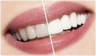 отбеливание и профессиональная чистка зубов